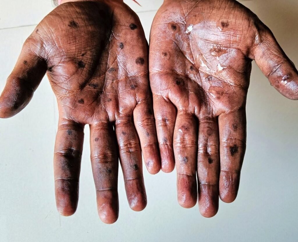 Mpox lesions on hands