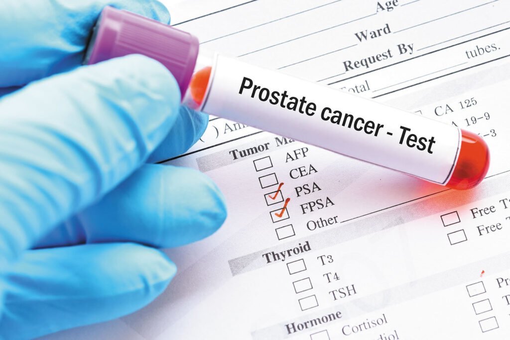 Prostate cancer image